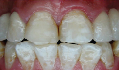 Tại sao răng có đốm trắng đục như nước gạo?