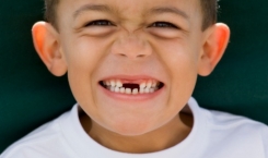 Những thói quen xấu khiến bé bị sâu răng