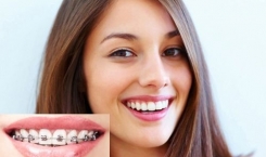 Những nguy cơ tiềm ẩn mà bạn cần tìm hiểu khi niềng răng